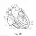 Fig. 22 - Percutaneous valve repair by reshaping and resizing right ventricle