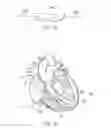 Fig. 23 - Percutaneous valve repair by reshaping and resizing right ventricle