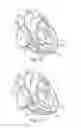 Fig. 24 - Percutaneous valve repair by reshaping and resizing right ventricle