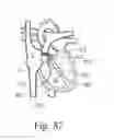 Fig. 28 - Percutaneous valve repair by reshaping and resizing right ventricle