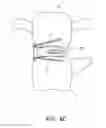 Fig. 09 - Lateral interbody fusion devices, systems and methods