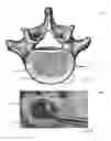 Fig. 02 - EXPANDABLE TRIAL WITH TELESCOPIC STABILIZERS