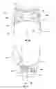Fig. 15 - Orthopedic device for treating complications of the hip