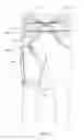 Fig. 29 - Orthopedic device for treating complications of the hip