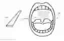 Fig. 01 - Tissue crosslinking for treatment of snoring and obstructive sleep apnea