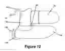 Fig. 09 - Cuspid and first bi-cuspid bite retainer for sleep apnea