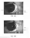 Fig. 14 - Systems, methods, and devices for cannula insertion