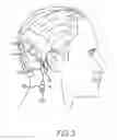 Fig. 04 - Optical microphone for implantable hearing instrument