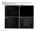 Fig. 11 - COMPOSITION FOR REGENERATING NORMAL TISSUE FROM FIBROTIC TISSUE
