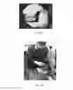 Fig. 02 - Spinal disc regenerative composition and method of manufacture and use