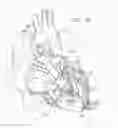Fig. 11 - Ventricular assist device for intraventricular placement