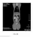 Fig. 11 - DIRECT PRESSURE-MEDIATED INTRA-BONE DELIVERY SYSTEM FOR CELLULAR THERAPEUTICS