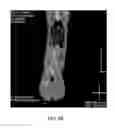 Fig. 12 - DIRECT PRESSURE-MEDIATED INTRA-BONE DELIVERY SYSTEM FOR CELLULAR THERAPEUTICS