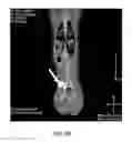Fig. 13 - DIRECT PRESSURE-MEDIATED INTRA-BONE DELIVERY SYSTEM FOR CELLULAR THERAPEUTICS