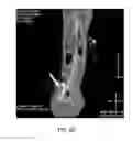 Fig. 14 - DIRECT PRESSURE-MEDIATED INTRA-BONE DELIVERY SYSTEM FOR CELLULAR THERAPEUTICS