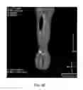 Fig. 15 - DIRECT PRESSURE-MEDIATED INTRA-BONE DELIVERY SYSTEM FOR CELLULAR THERAPEUTICS