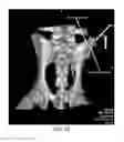 Fig. 20 - DIRECT PRESSURE-MEDIATED INTRA-BONE DELIVERY SYSTEM FOR CELLULAR THERAPEUTICS