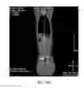 Fig. 22 - DIRECT PRESSURE-MEDIATED INTRA-BONE DELIVERY SYSTEM FOR CELLULAR THERAPEUTICS