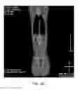 Fig. 23 - DIRECT PRESSURE-MEDIATED INTRA-BONE DELIVERY SYSTEM FOR CELLULAR THERAPEUTICS