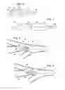 Fig. 03 - APPARATUS AND METHOD FOR DEPLOYMENT OF A BRONCHIAL OBSTRUCTION DEVICE