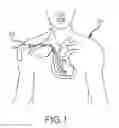Fig. 02 - Surgical instrument for removing an implanted object