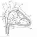 Fig. 01 - Interventional medical systems, tools, and methods of use