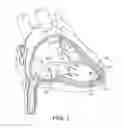Fig. 02 - Interventional medical systems, tools, and methods of use