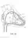 Fig. 04 - Interventional medical systems, tools, and methods of use
