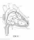 Fig. 12 - Interventional medical systems, tools, and methods of use