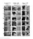Fig. 04 - Nanosecond pulsed electric fields cause melanomas to self-destruct