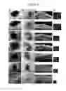 Fig. 06 - Nanosecond pulsed electric fields cause melanomas to self-destruct