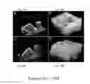Fig. 11 - Nanosecond pulsed electric fields cause melanomas to self-destruct