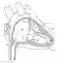 Fig. 01 - Interventional medical systems, tools, and methods of use