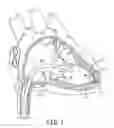 Fig. 02 - Interventional medical systems, tools, and methods of use