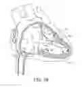 Fig. 04 - Interventional medical systems, tools, and methods of use