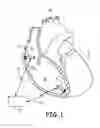 Fig. 02 - Multi-chamber intracardiac pacing system