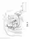 Fig. 10 - Multi-chamber intracardiac pacing system