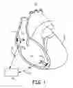Fig. 02 - Multi-chamber intracardiac pacing system