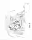 Fig. 10 - Multi-chamber intracardiac pacing system
