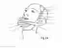 Fig. 08 - Exercise apparatus for the jaw and facial muscles