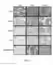 Fig. 04 - METHODS AND MATERIALS FOR IDENTIFYING AND TREATING MAMMALS HAVING LUNG ADENOCARCINOMA CHARACTERIZED BY NEUROENDOCRINE DIFFERENTIATION
