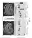Fig. 17 - Systems and methods for generating biomarkers based on multivariate classification of functional imaging and associated data