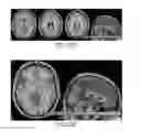 Fig. 32 - Systems and methods for generating biomarkers based on multivariate classification of functional imaging and associated data