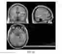Fig. 33 - Systems and methods for generating biomarkers based on multivariate classification of functional imaging and associated data