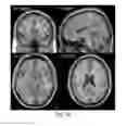 Fig. 35 - Systems and methods for generating biomarkers based on multivariate classification of functional imaging and associated data