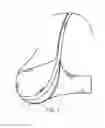 Fig. 17 - BRA WITH ADVANCED ANATOMICAL SUPPORT