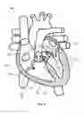 Fig. 11 - Apparatus, system and methods for measuring a blood pressure gradient