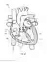 Fig. 12 - Apparatus, system and methods for measuring a blood pressure gradient
