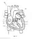 Fig. 13 - Apparatus, system and methods for measuring a blood pressure gradient
