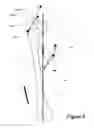 Fig. 05 - METHOD AND APPARATUS FOR DETERMINING A LEG LENGTH DIFFERENCE AND A LEG OFFSET